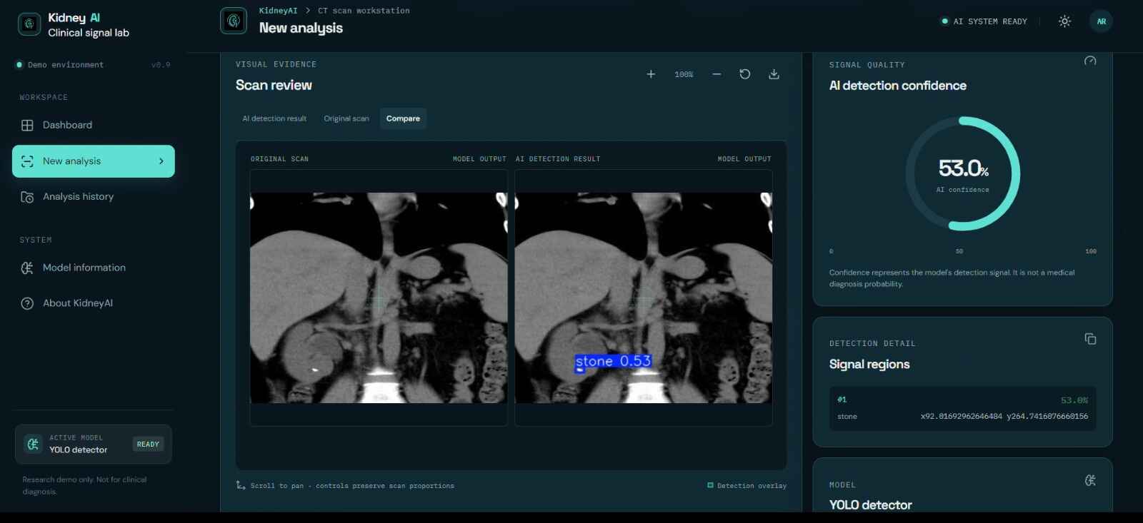 Kidney Stone detection preview
